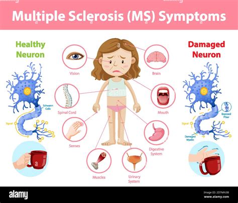 multiple sklerose symptome